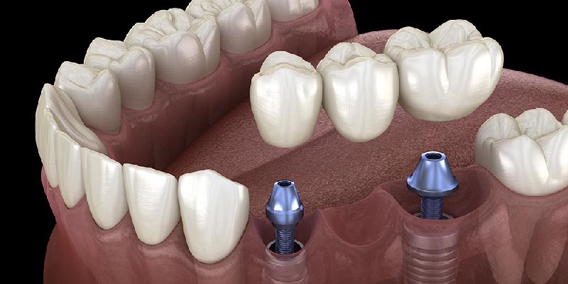 Diş Implantları