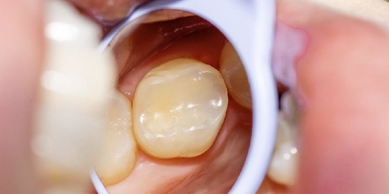 Aesthetic and Porcelain Fillings