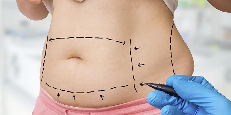 Abdominoplastie