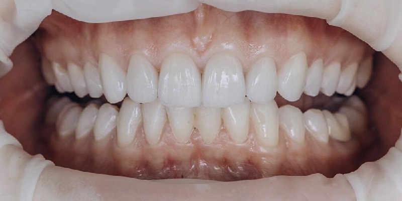 Dents et couronnes en zirconium